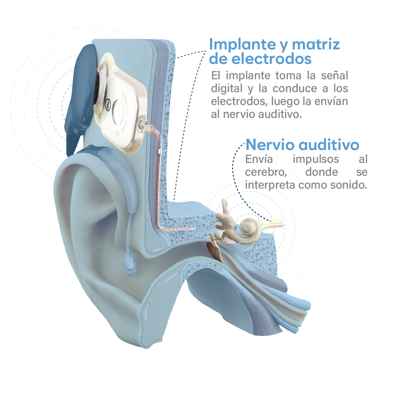 Como funciona un implante coclear_Mesa de trabajo 1 copia 2