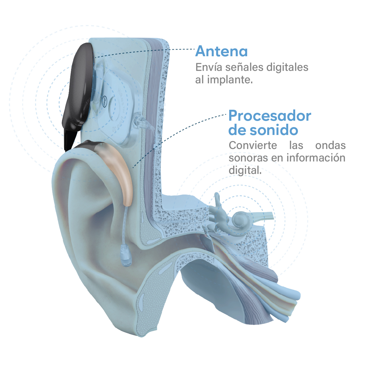 Como funciona un implante coclear_Mesa de trabajo 1 copia
