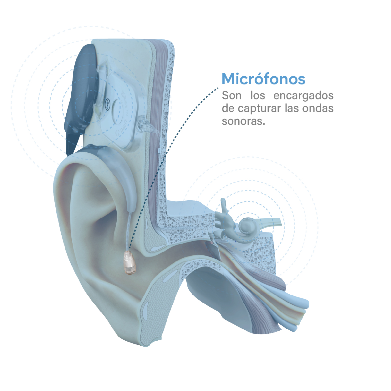 Como funciona un implante coclear_Mesa de trabajo 1